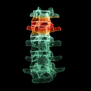 3D image of spinal vertebrae highlighting injury area, representing advancements in spinal diagnosis - Evident Health